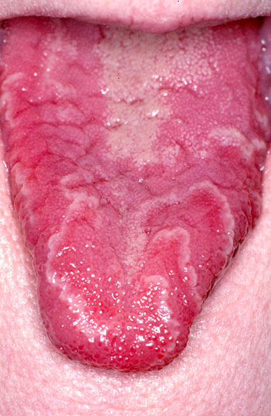 Example of Yeast Infections- Photo