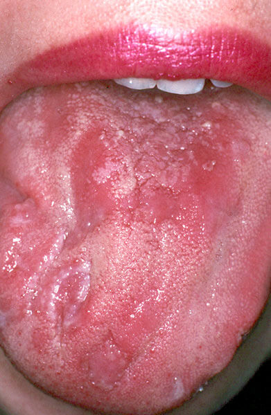 Example of Yeast Infections- Photo