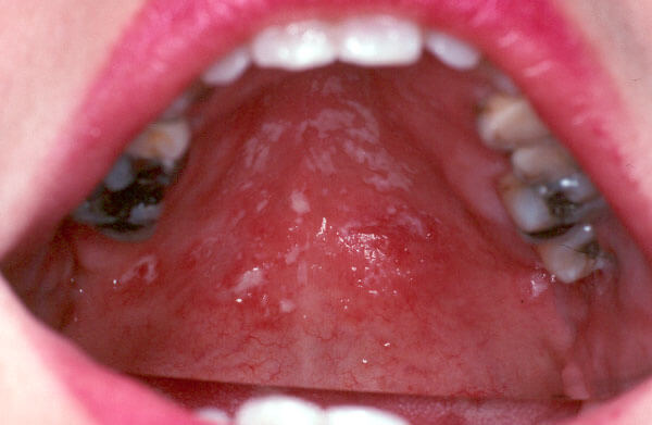 Example of Yeast Infections- Photo