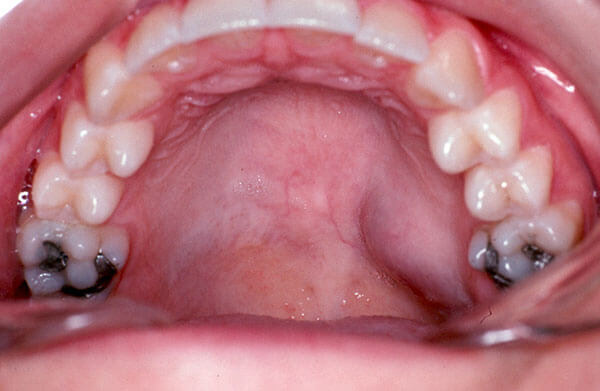 White Lump On Floor Of Mouth