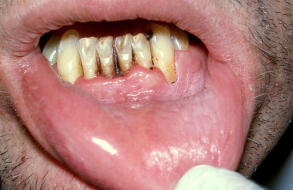 Example of Tobacco Chewing- Photo