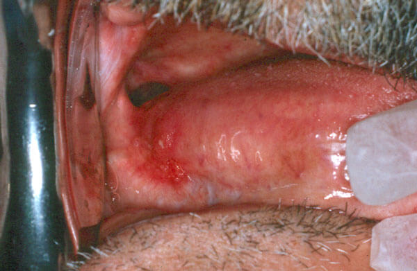 Ulcers -Photo