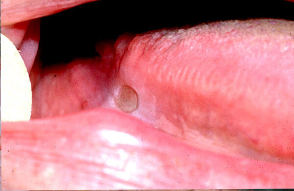 Ulcers -Photo