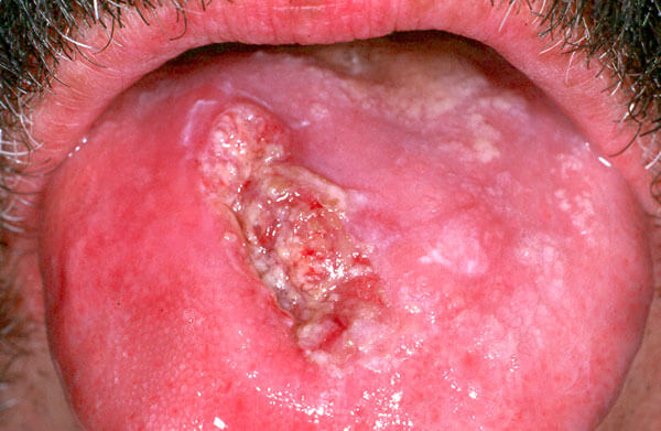 Ulcers -Photo