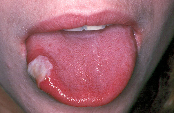 Ulcers -Photo