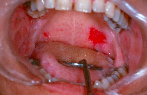 Ulcers -Photo