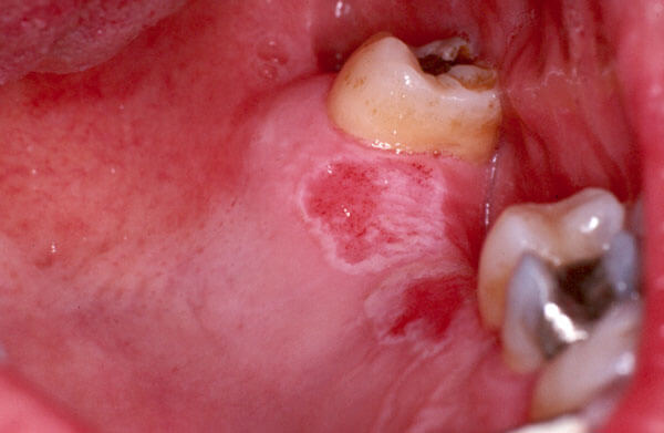 Ulcers -Photo