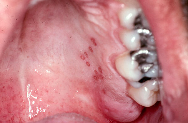 Ulcers -Photo