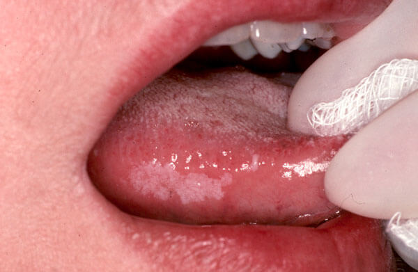 Diagnostic Changes in Mucosa-Photo