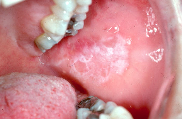 Diagnostic Changes in Mucosa-Photo