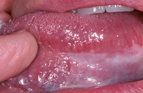 Diagnostic Changes in Mucosa-Photo