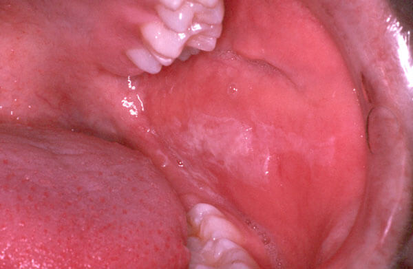 Diagnostic Changes in Mucosa-Photo