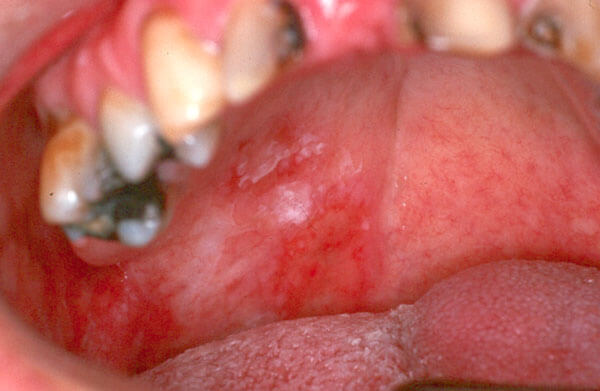 Diagnostic Changes in Mucosa-Photo