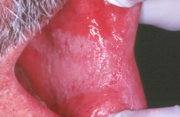 Diagnostic Changes in Mucosa-Photo